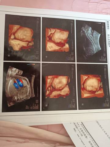 五个月四维彩超胎儿图片