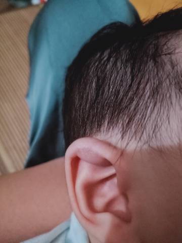 宝宝今天四个多月了,前几天才注意到耳朵轮廓里面长了一个鼓包,捏着