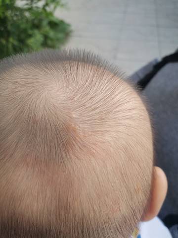 新生儿头上皮脂腺痣图片