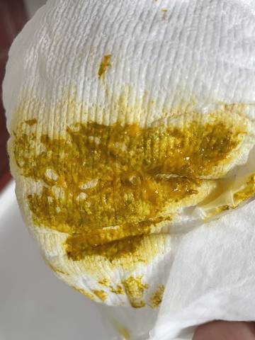 50天宝宝腹泻,大便有粘液,吐奶渣,哭闹.