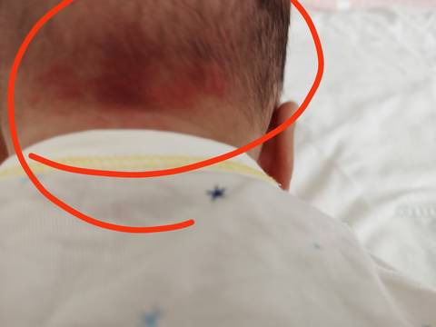 新生儿枕后红斑图片