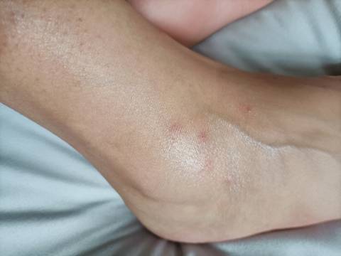 孕中期,前几天脚腕开始长这种小红疙瘩,超级痒,一开始以为是蚊虫咬了