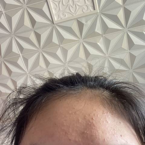 你们孕期额头上也长这样的痘痘吗