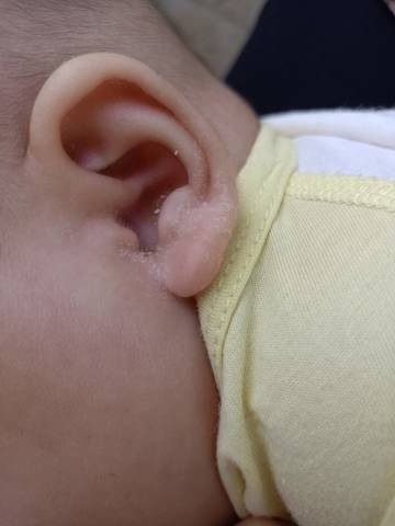 宝宝耳朵长癣图片图片