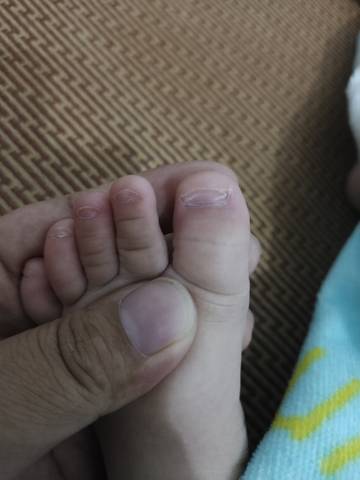 10个月的宝宝,这个脚趾甲为啥有白的