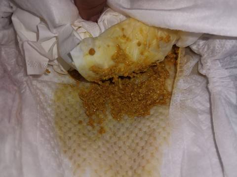 半岁以上的婴儿可服用鱼蛋白粉粥或烂面条由于鱼蛋白粉内蛋白质质量高