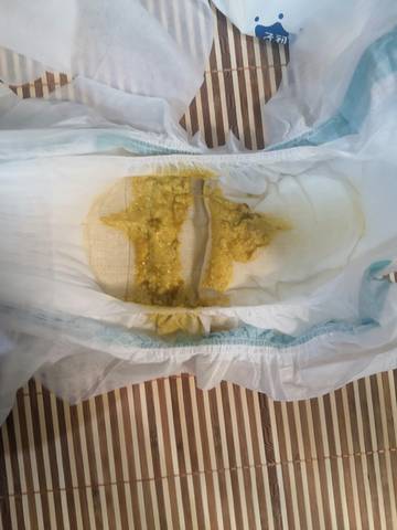 我家宝宝两个月前都是隔两天拉一次屎,很臭,粘稠,突然间宝宝一天拉三