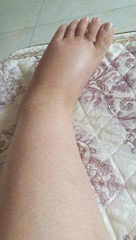 三十五周了,脚和腿肿成这样,正常吗