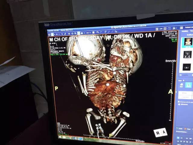 印度现罕见连体双胞胎,预防胎儿畸形孕妈牢记10原则