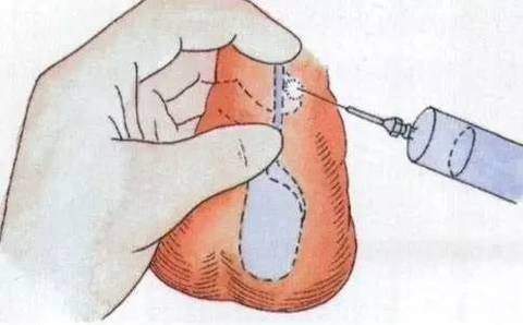 好奇,结扎后精子去哪了?